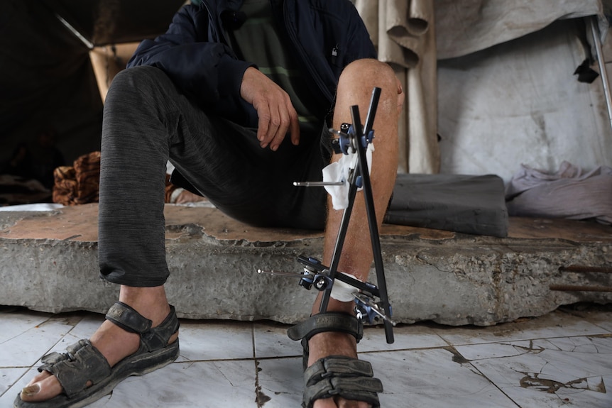A man sits on a low concrete blog inside a tent, one of his legs held by metal scaffolding.