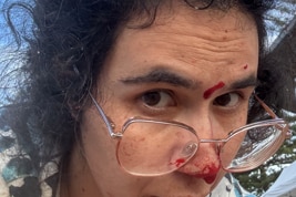 A Bondi terror attack survivor with a bloody face.