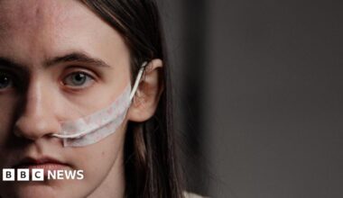 Young woman with dark hair and a nasogastric tube