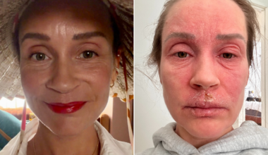 Eczema sufferer offers hope after life ‘stripped away’ by topical steroid withdrawal