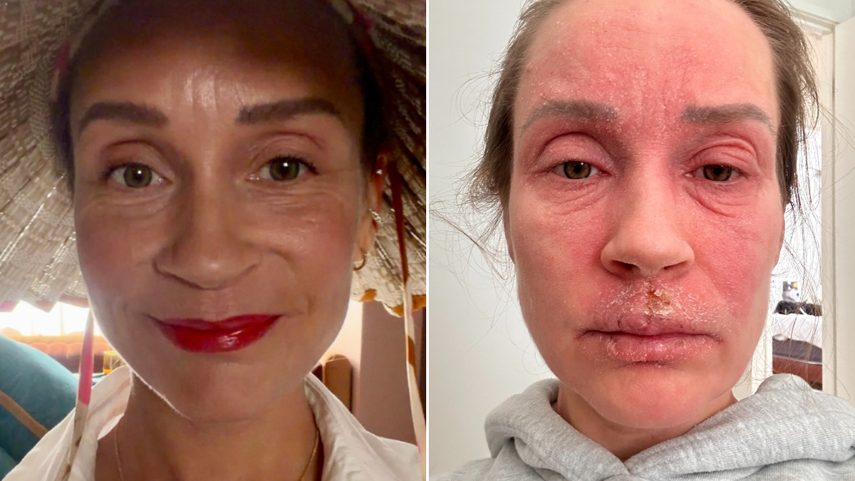 Eczema sufferer offers hope after life ‘stripped away’ by topical steroid withdrawal