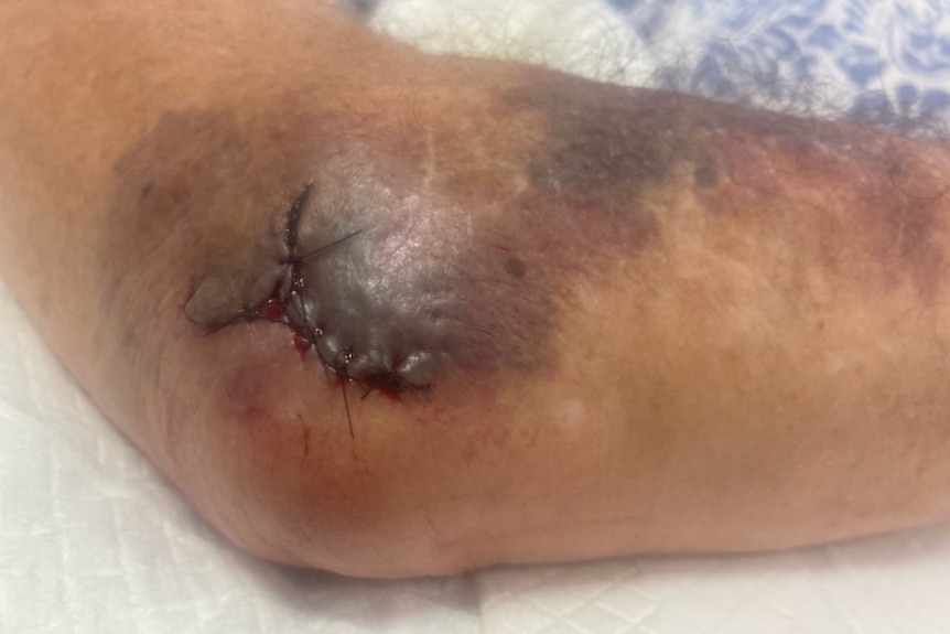 A bruised elbow up close.