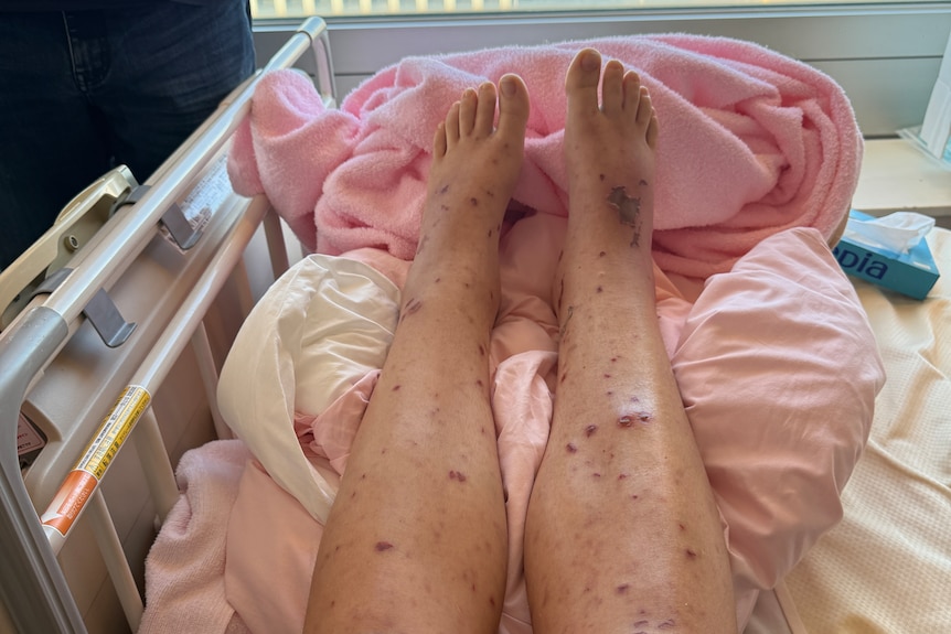 A woman's outstretched legs with dark splotchy lesions all over them.