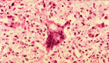 Disease spreading in stealth in Sydney