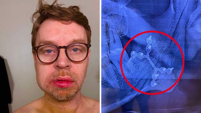 Hayes in April revealed the extent of his injuries. 