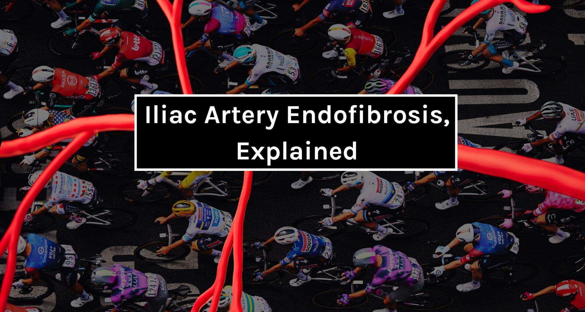 Understanding iliac artery endofibrosis