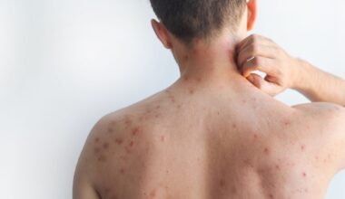 Measles alert for Lismore area after confirmed case at hospital