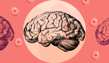 Early Phase iPSC Therapy Trial for Parkinson's Disease