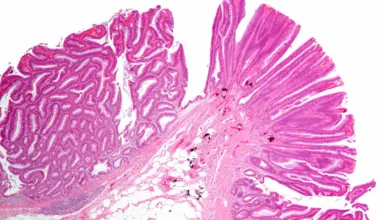 Colorectal Dysplasia Risk in Long-Term IBD Study