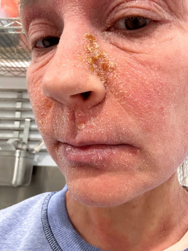 Hein started experiencing frequent eczema flare-ups.