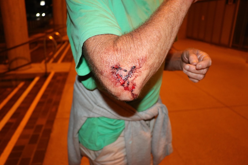 A man wearing a green t-shirt showing his elbow which has large bleeding lacerations