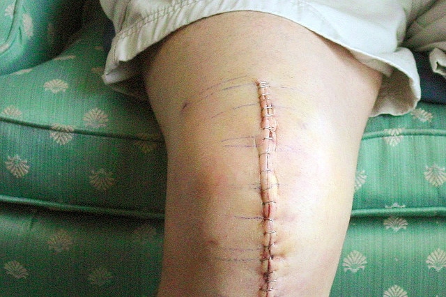 Total Knee Replacement