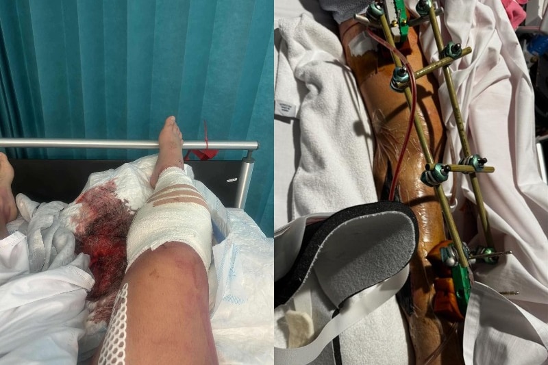 An image of an injured leg on a hospital bed