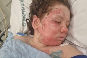 Girl with a red, burnt face sleeps in a hospital bed.