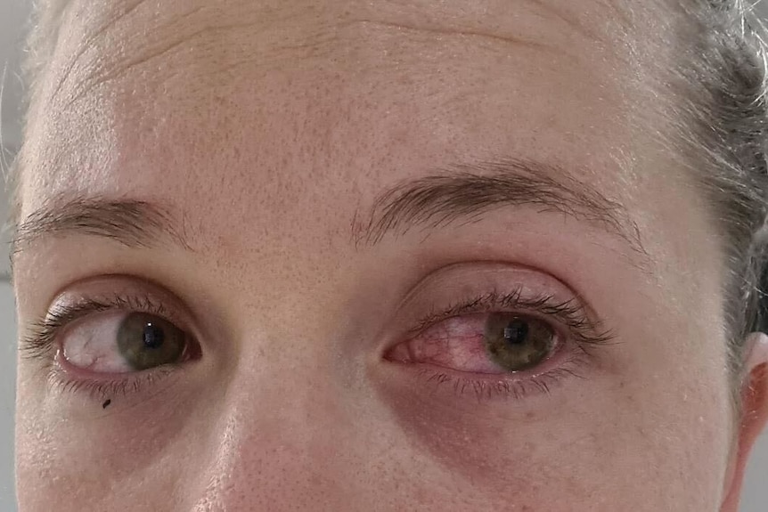 Close up of a woman's face, with a bloodshot eye. 