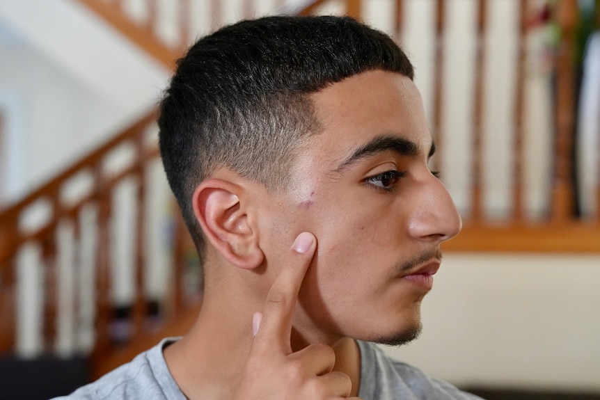 Teenager Nadel points to a bruise on his temple.