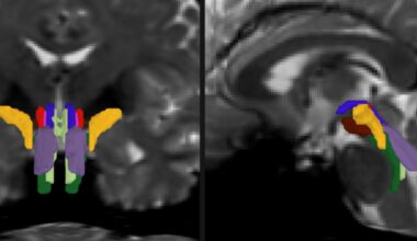 AI Tracks Vital White Matter Pathways