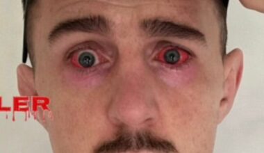 Tom Aspinall shows off horrific red eyes ‘1 day post surgery’