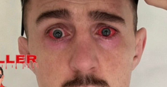 Tom Aspinall shows off horrific red eyes ‘1 day post surgery’