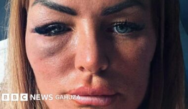 'Nangiye umurwanyi wa MMA aho twari mu kabari ankubita ingumi yangije ubuzima bwanjye