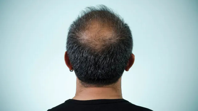 A balding man from behind