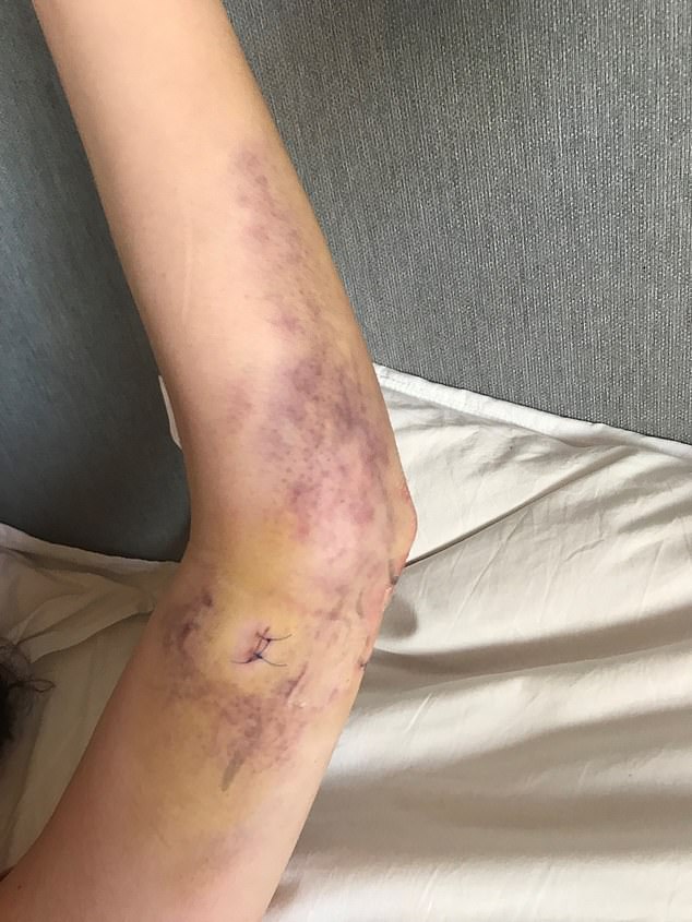 Her most recent operation, to repair nerve damage, has been the third on her arm