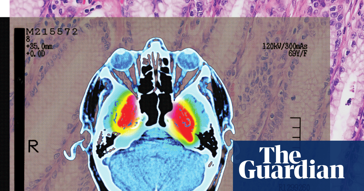 ‘Strong evidence’ of lowered dementia risk: the benefits of shingles vaccination | Well actually