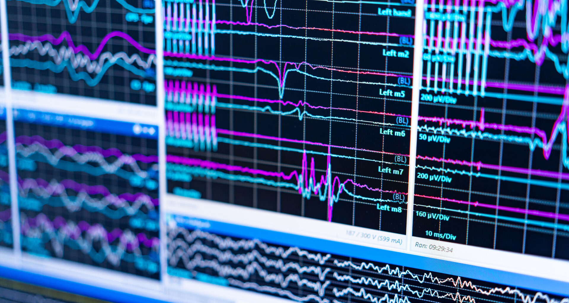 Early schizophrenia signs may hold key to preventing psychosis