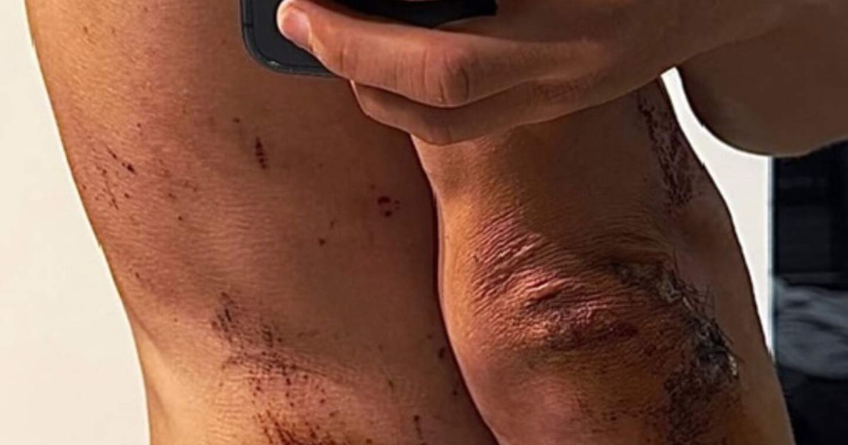 No broken bones, but Kwiatkowski shares grim images of heavy Milan-San Remo crash damage