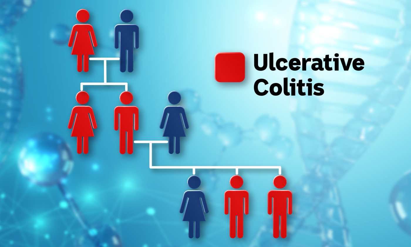 A graphic displaying the genetic pattern of ulcerative colitis