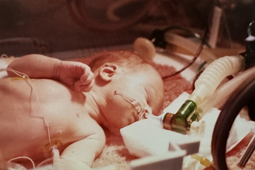 Newborn baby lies on his back with a ventilator attached to his nose, surrounded by medical equipment