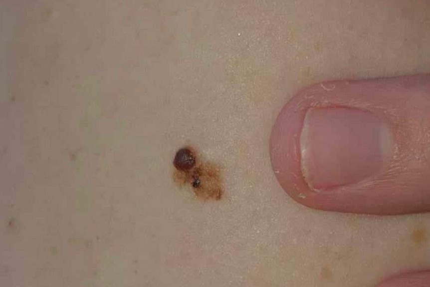 A dark brown irregular shaped spot on a pale section of skin