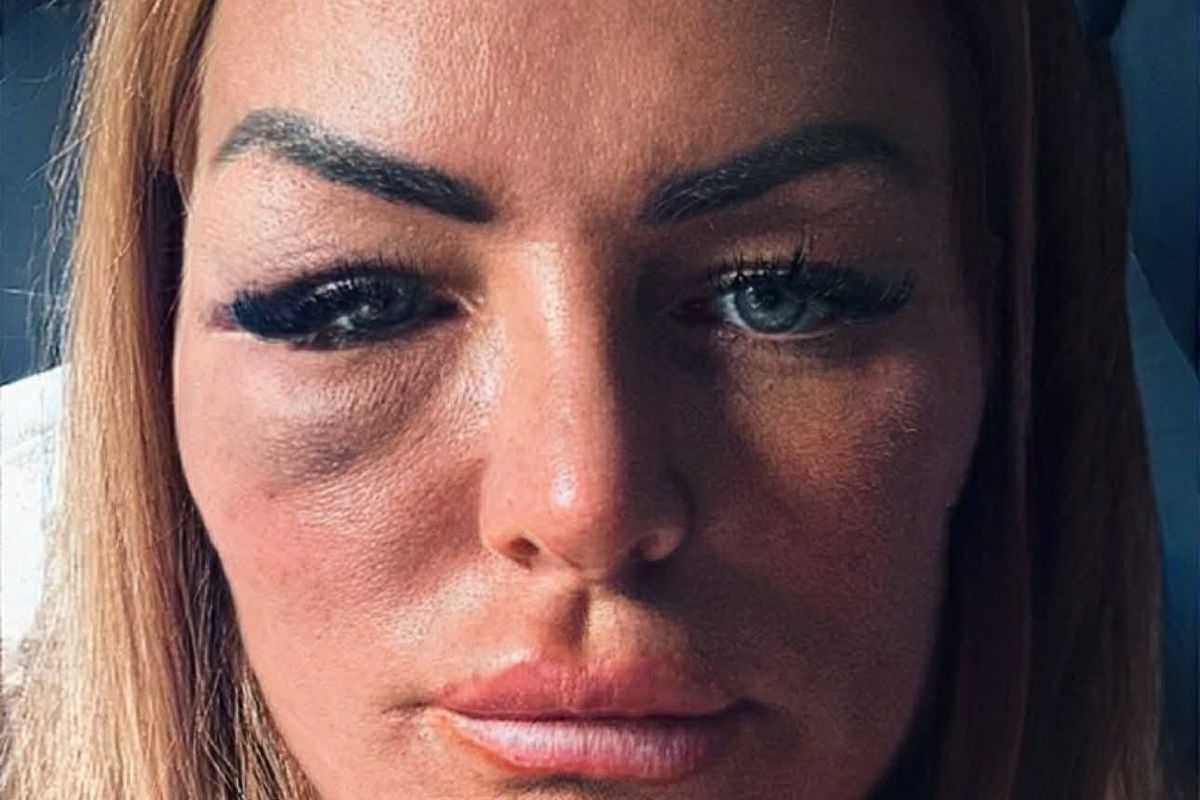 Anne Marie was left with a broken eye socket and cheek bone as a result of the savage attack. 