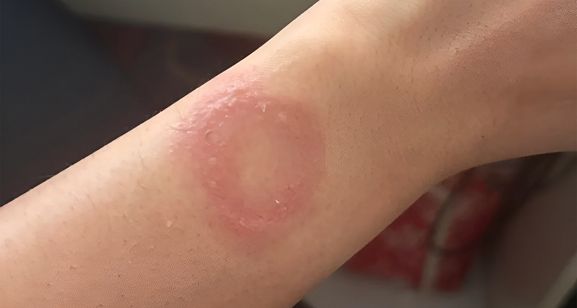 Apple Watch owner says the wearable caused a wrist burn