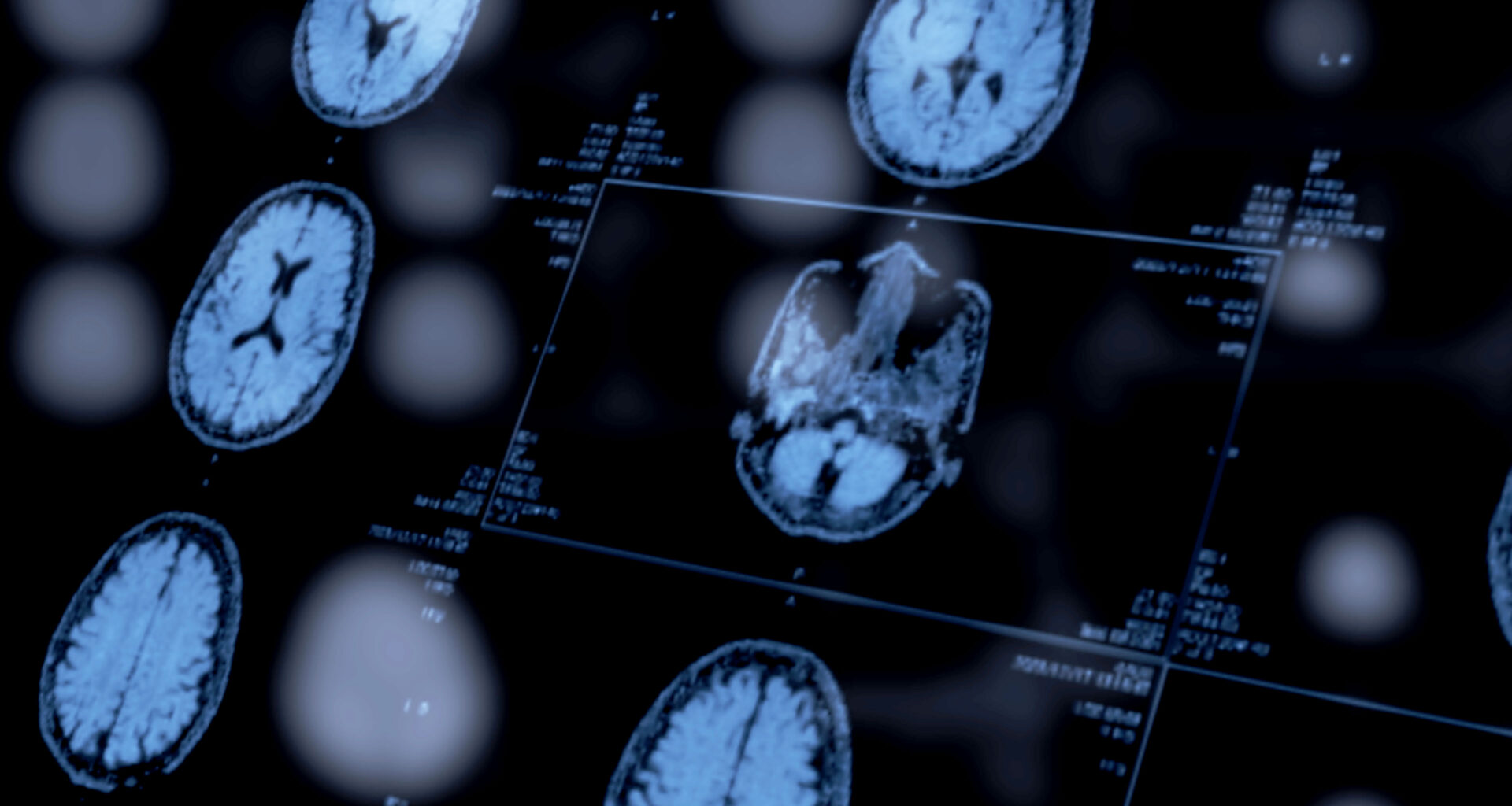 An image of several brain scans on a screen.