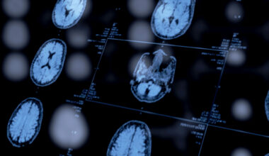 An image of several brain scans on a screen.