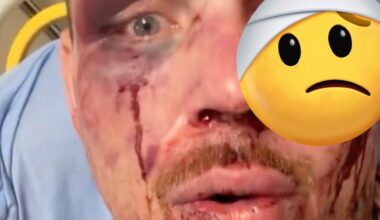 Steven Asplund shows mangled face after UFC Vegas 114 war