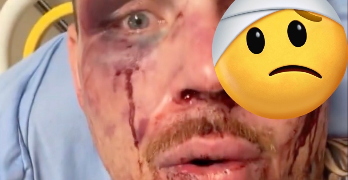 Steven Asplund shows mangled face after UFC Vegas 114 war