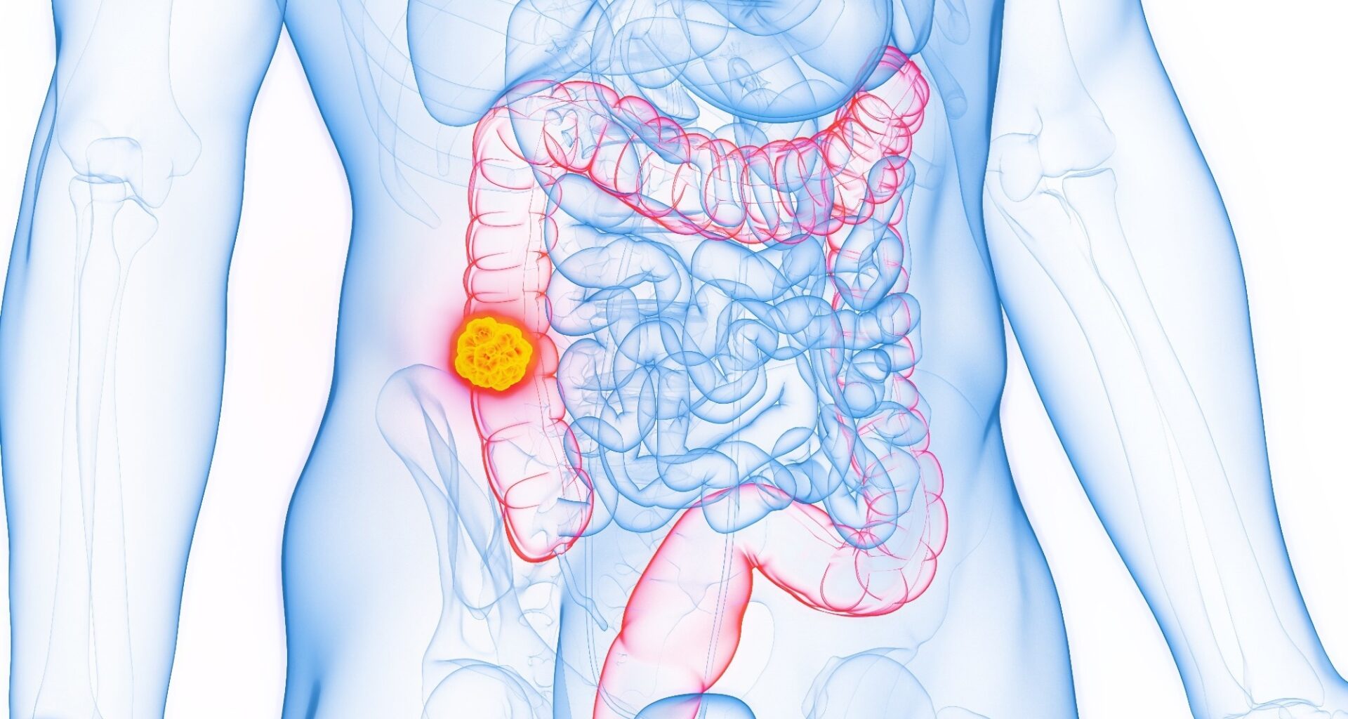 3D Rendered Medical Illustration of Male Anatomy - Colon Cancer; Ascending Colon. Plain White Background.