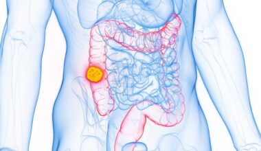 3D Rendered Medical Illustration of Male Anatomy - Colon Cancer; Ascending Colon. Plain White Background.