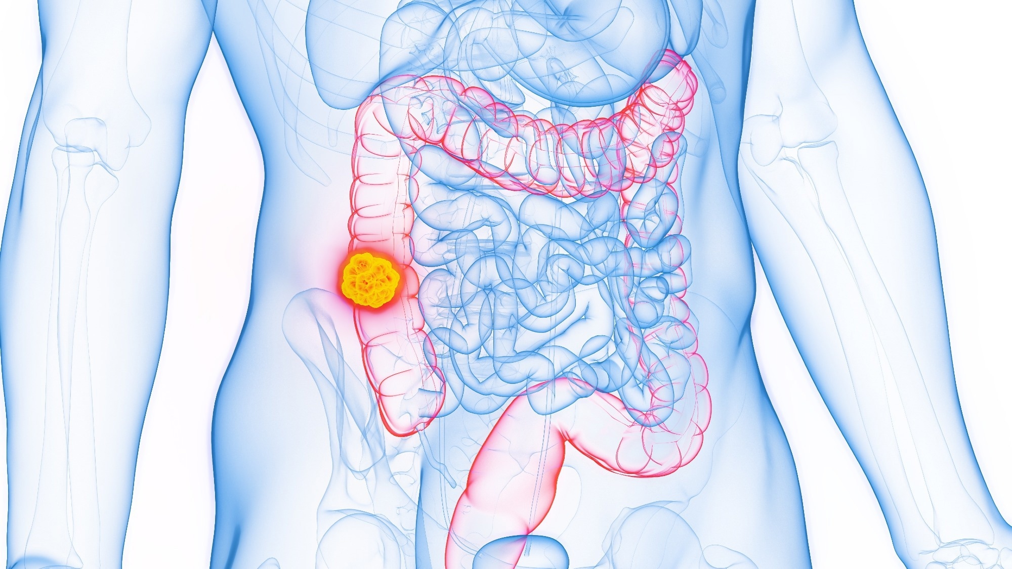 3D Rendered Medical Illustration of Male Anatomy - Colon Cancer; Ascending Colon. Plain White Background.