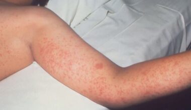 Department of Health confirms measles case in Oahu visitor, issues exposure alert