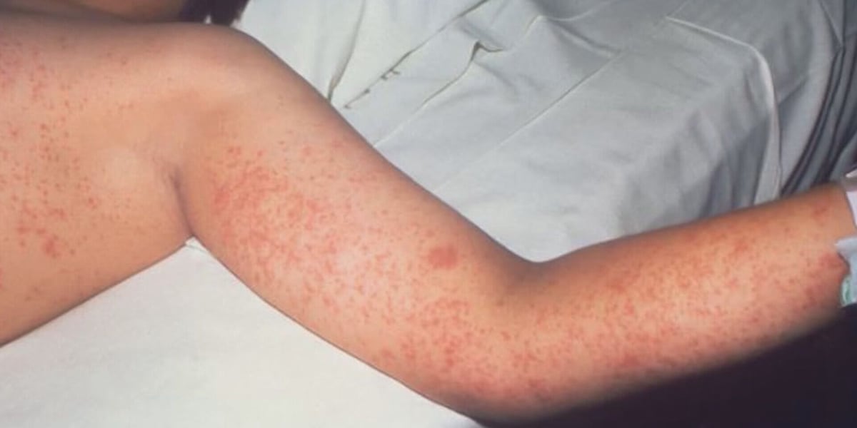Department of Health confirms measles case in Oahu visitor, issues exposure alert