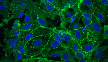 Genetic Cause of Leaky Brain Vessels in Rett Found