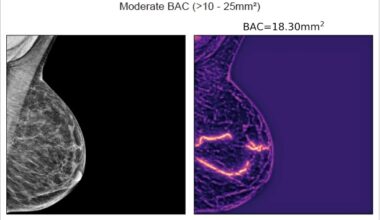 ] ‘Artificial intelligence–based quantification of breast arterial calcifications to predict cardiovascular morbidity and mortality’, by T. Dapamede et al., European Heart Journal, https://doi.org/10.1093/eurheartj/ehag128.