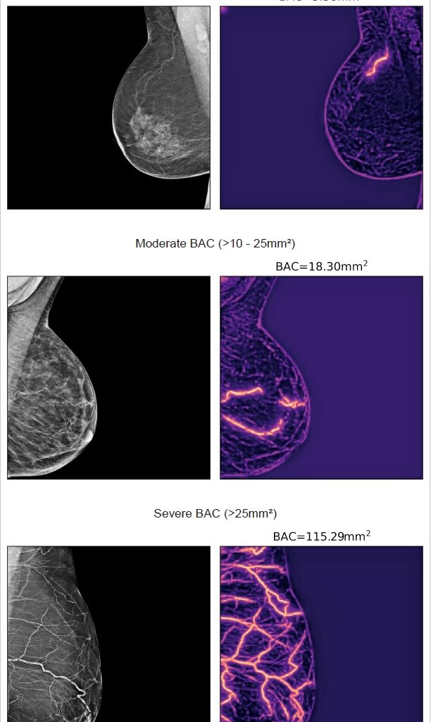 ] ‘Artificial intelligence–based quantification of breast arterial calcifications to predict cardiovascular morbidity and mortality’, by T. Dapamede et al., European Heart Journal, https://doi.org/10.1093/eurheartj/ehag128.