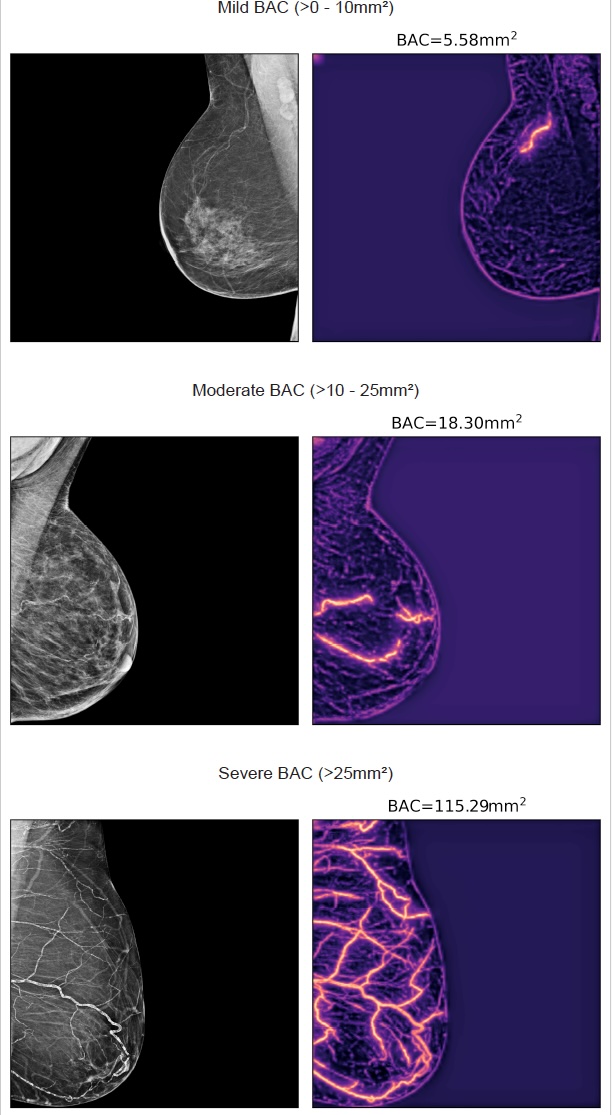 ] ‘Artificial intelligence–based quantification of breast arterial calcifications to predict cardiovascular morbidity and mortality’, by T. Dapamede et al., European Heart Journal, https://doi.org/10.1093/eurheartj/ehag128.