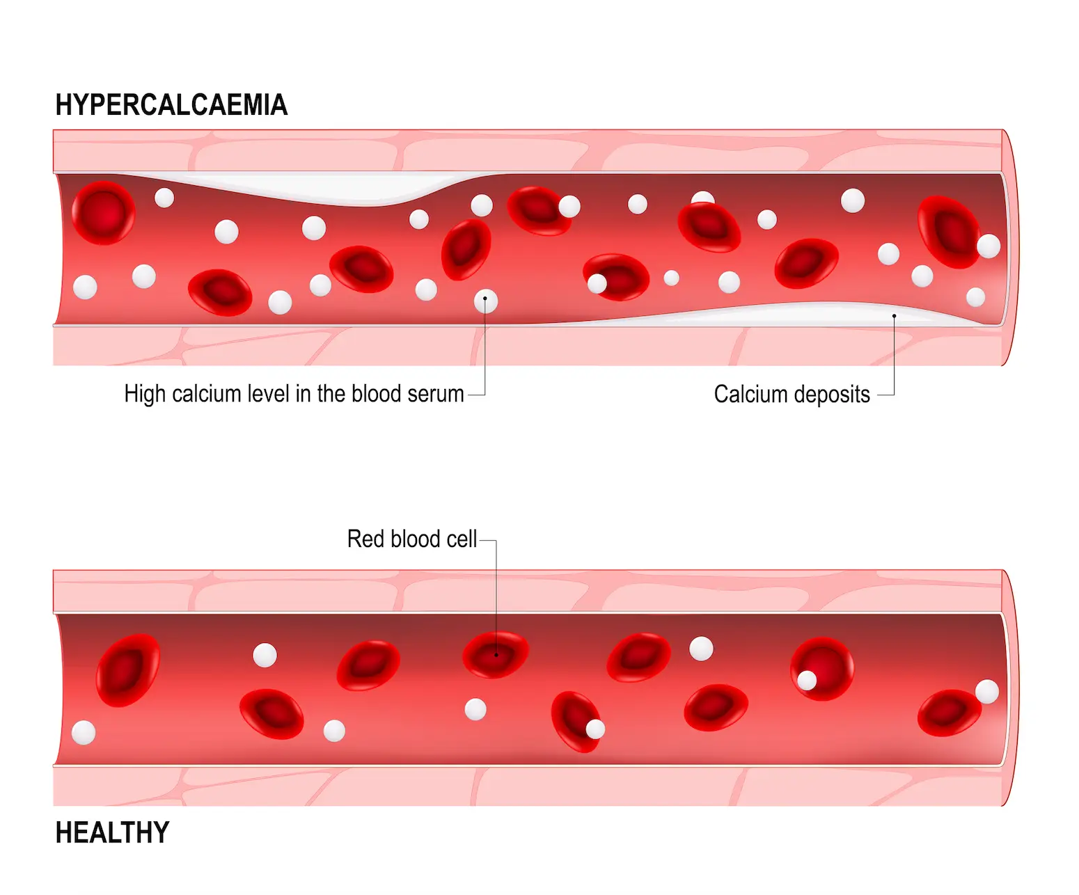 Hypercalcaemia is when the calcium level in the blood becomes too high (Getty Stock Images)