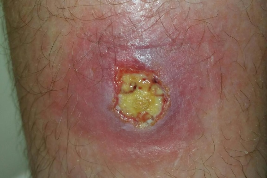 A case of the flesh-eating bacteria from the Mornington Peninsula