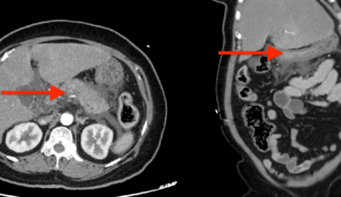 Semaglutide-Associated Acute Pancreatitis in a Patient With Type 2 Diabetes Mellitus: A Case Report